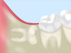 親知らずを抜いたほうがいい場合2