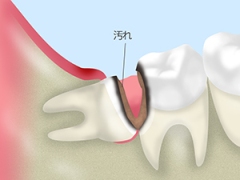 親知らずのむし歯
